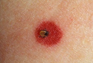 Lyme disease spreading as ticks cross border