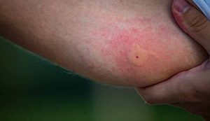 Scratching mosquito bites significantly prolongs itch item-thumbnail